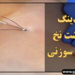 امبدینگ یا کاشت نخ در طب سوزنی