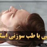 اموزش طب سوزنی اسکالپ